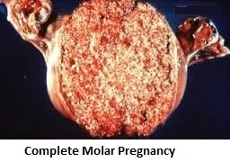 Molar Pregnancy Cyst