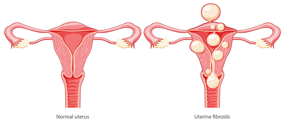 Uterine fibroid removal, myomectomy